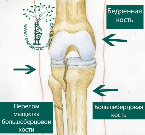 Следующие виды травм мыщелка коленного сустава являются наиболее распространенными: